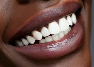 Blanchiment dentaire avec GlorySmile V34 Colour Corrector – (30ml)